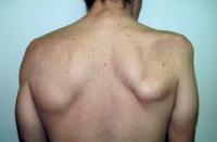 Scapular winging from long thoracic nerve palsy
