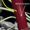 3D Rendering of Winging Scapula Surgery 