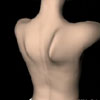 3D Rendering of Winging Scapula Surgery 