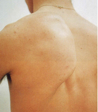 Treatment of the suprascapular injury is directed at rehabilitation.